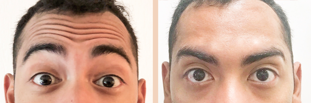 before and after botulinum toxin forehead